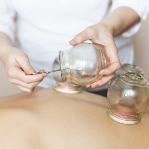 Cupping treatment | Beach Acupuncture